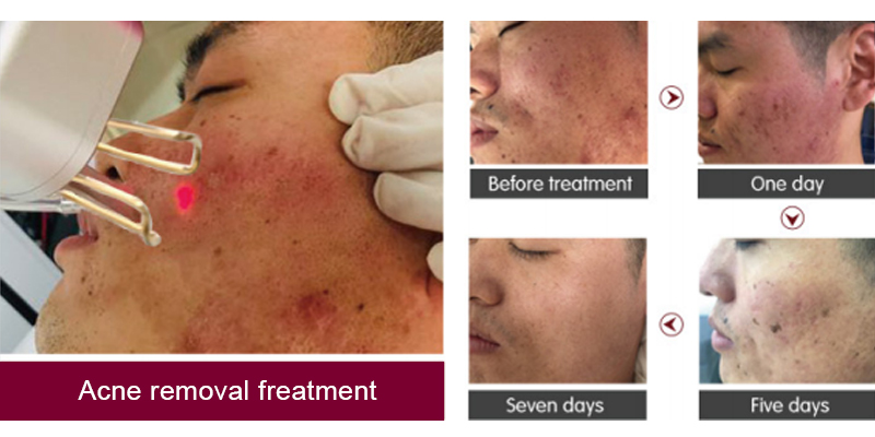 co2 laser for scars