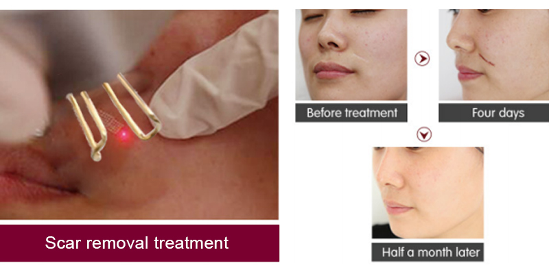 co2 laser for acne scars