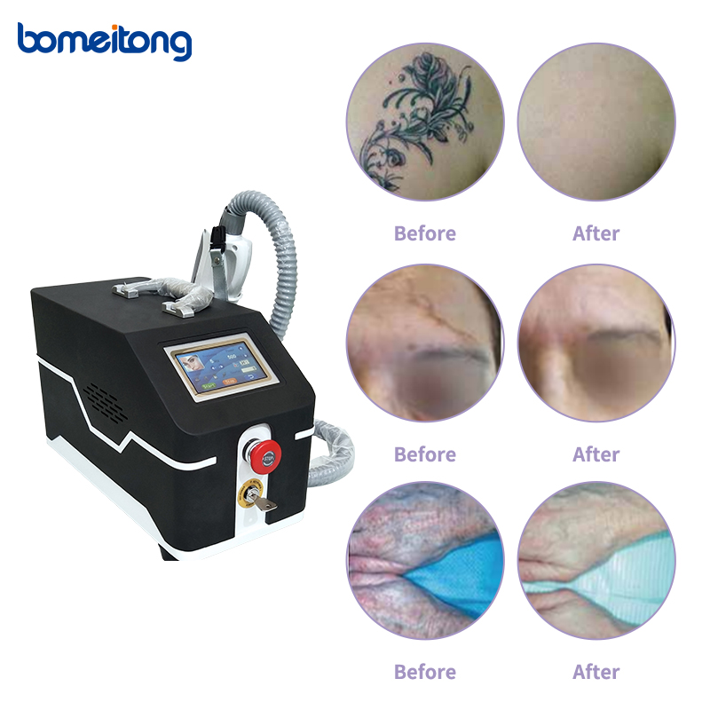 Laser Scar Removal Tattoo Eraser Picosure Laser Machine from China